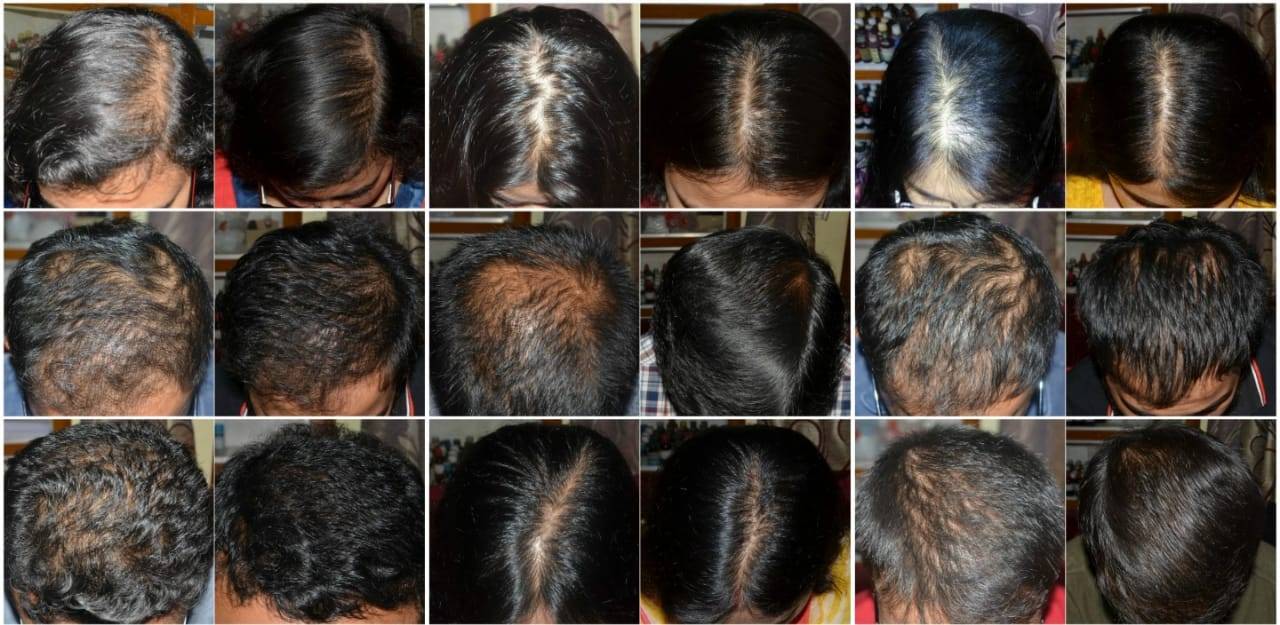 Types Of Hair Problem